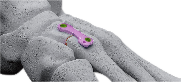 MetaFuse Midfoot Lisfranc Plate